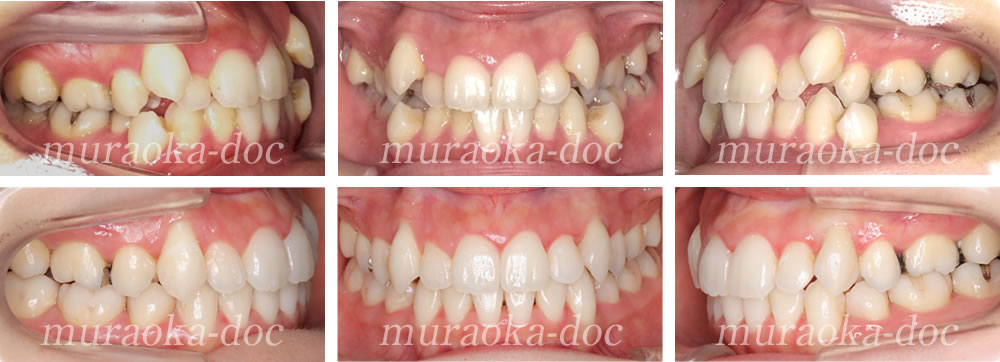 大人の叢生・八重歯の矯正治療例(期間1年11ヵ月)