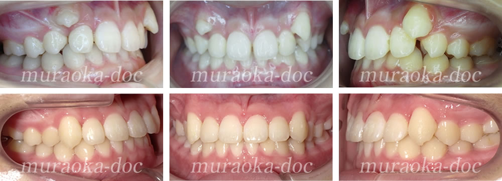 大人の叢生・八重歯の矯正治療例(期間1年6ヵ月)