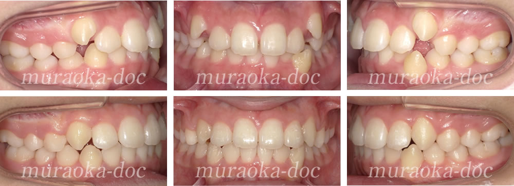 大人の八重歯・過蓋咬合の矯正治療例(期間9ヵ月)