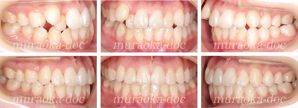 大人の叢生・八重歯の矯正治療例(期間1年9ヵ月)