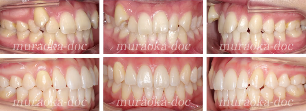 大人の叢生・八重歯の矯正治療例(期間1年6ヵ月)
