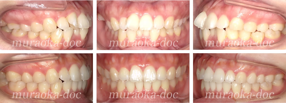 大人の叢生・凸凹の矯正治療例(期間1年3ヵ月)