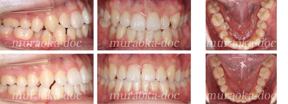 大人の叢生・凸凹の矯正治療例(期間1年2ヵ月)