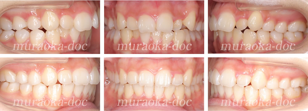 大人の叢生・凸凹の矯正治療例(期間1年7ヵ月)