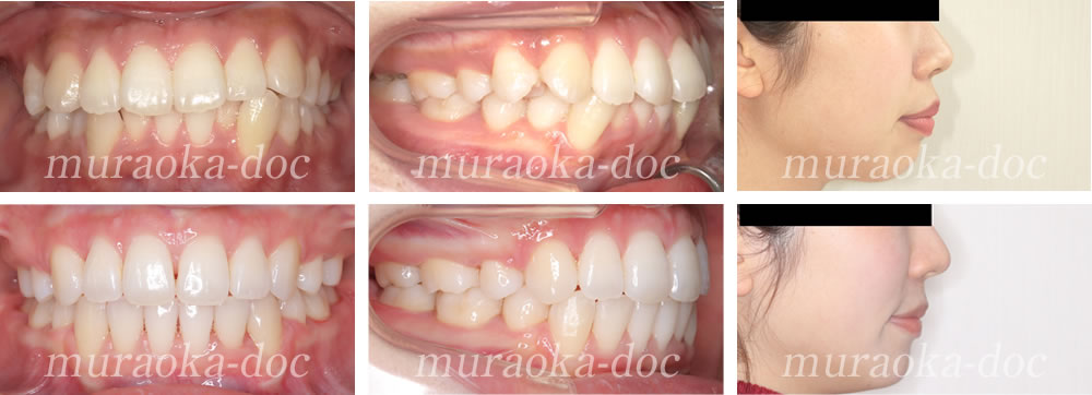 大人の上下顎前突の矯正治療例(期間1年10ヵ月)