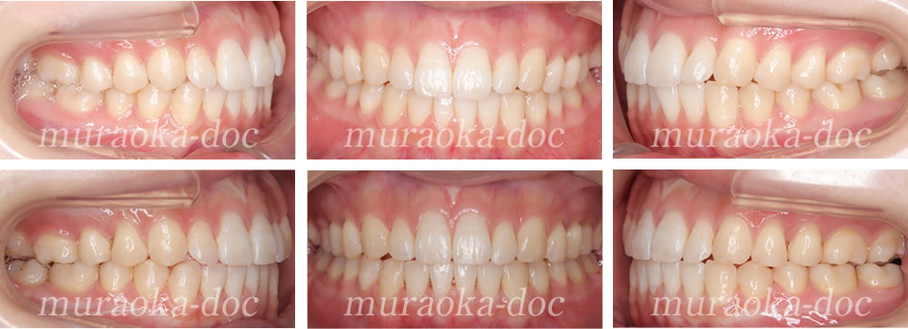 大人の叢生・凸凹の矯正治療例(期間1年3ヵ月)