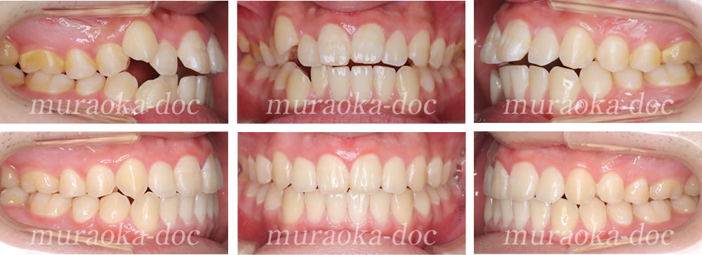 大人の叢生・凸凹・八重歯の矯正治療例(期間1年4ヵ月)