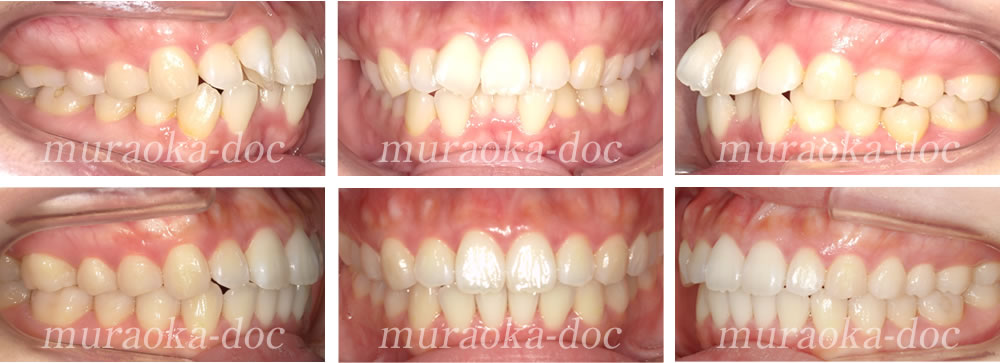 大人の叢生・凸凹・過蓋咬合の矯正治療例(期間1年5ヵ月)