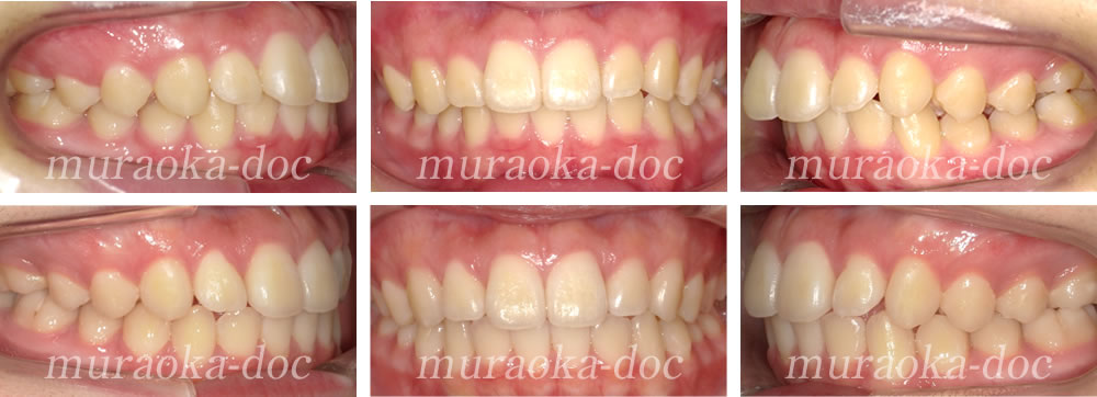 大人の上顎前突・出っ歯の矯正治療例(期間1年）