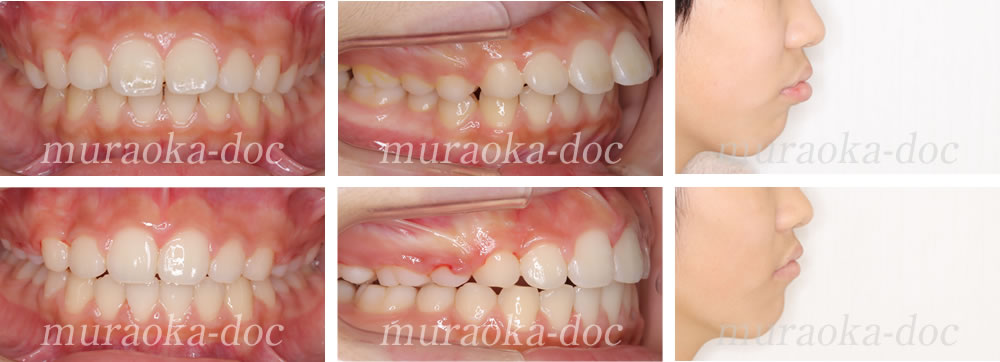 大人の上顎前突・出っ歯の矯正治療例(期間1年5ヵ月)