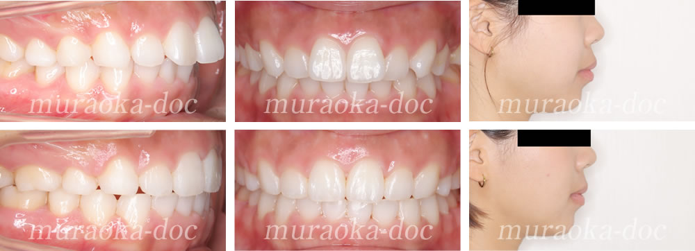 大人の上顎前突・出っ歯の矯正治療例(期間1年6ヵ月)