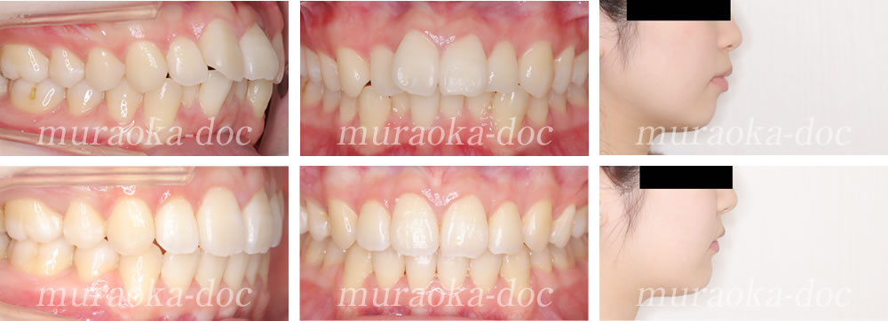 大人の叢生・上下顎前突・出っ歯の矯正治療例(期間1年8ヵ月)