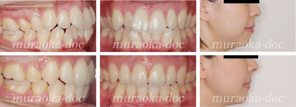 大人の叢生・上下顎前突・出っ歯の矯正治療例(期間1年6ヵ月)