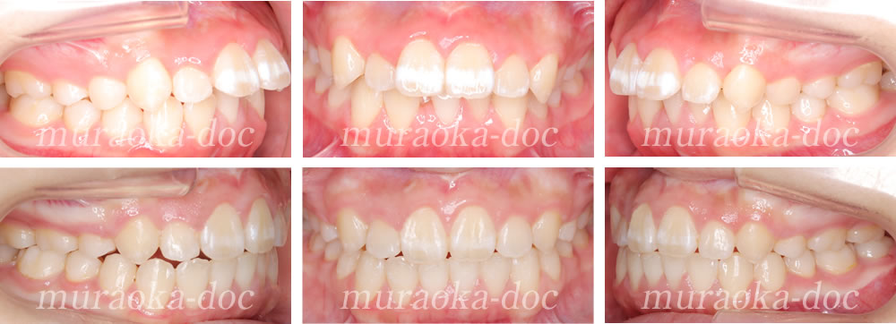 大人の出っ歯・叢生の矯正治療例(期間1年9ヵ月)