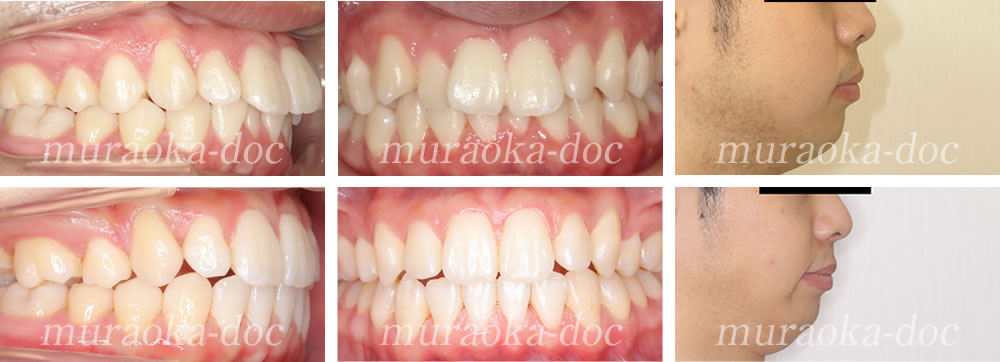 大人の過蓋咬合・上下顎前突の矯正治療例(期間2年)