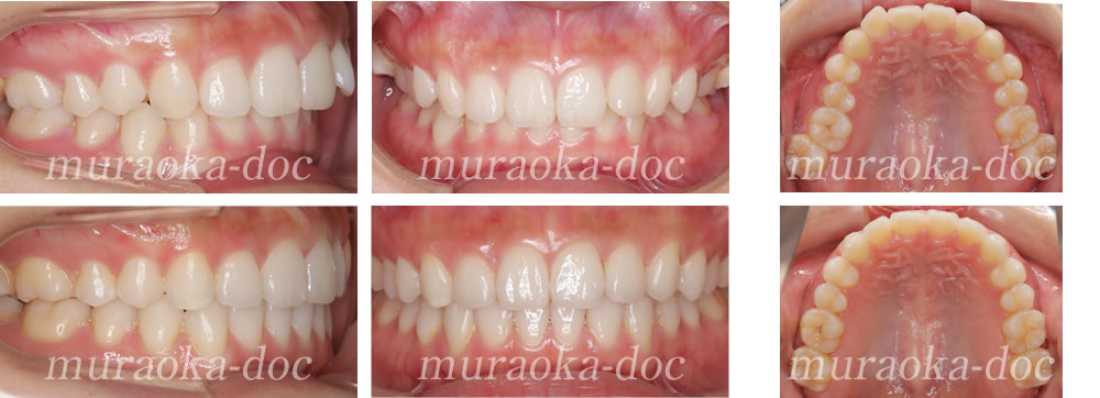 大人の過蓋咬合の矯正治療例(期間1年7ヵ月)