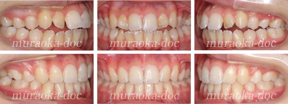 大人の開咬・叢生の矯正治療例(期間1年11ヵ月)