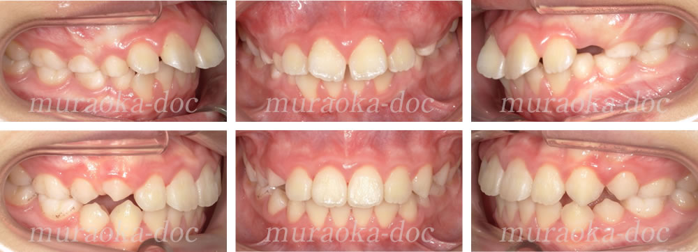 子どもの出っ歯の矯正治療例(期間10ヵ月)