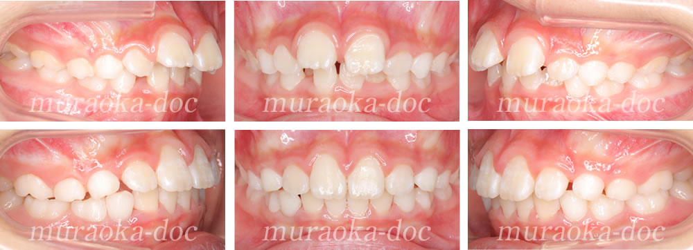 子どもの出っ歯・叢生の矯正治療例(期間1年3ヵ月)