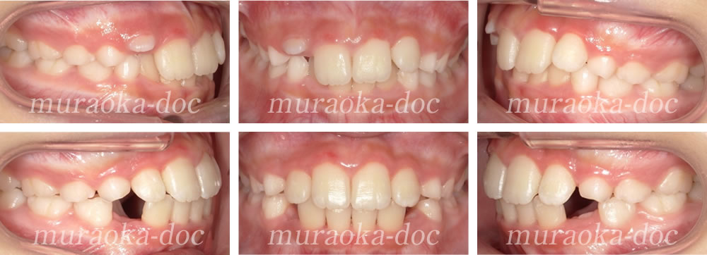子どもの過蓋咬合の矯正治療例(期間1年2ヵ月)