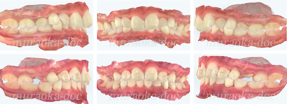子どもの過蓋咬合の矯正治療例(期間10ヵ月)