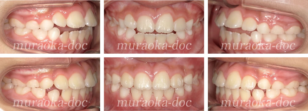 子どもの開咬の矯正治療例(期間1年3ヵ月)