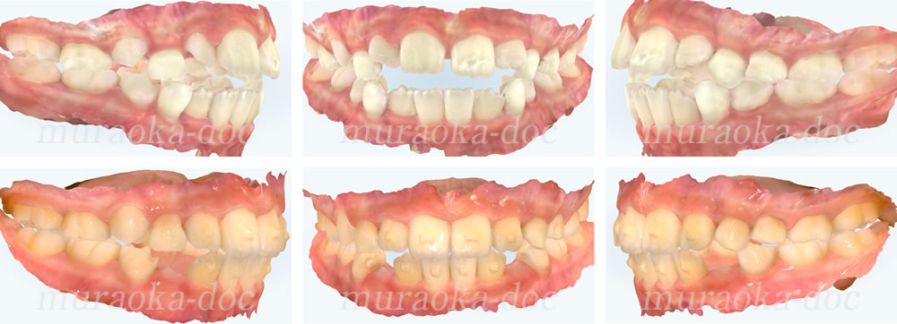 子どもの開咬の矯正治療例(期間9ヵ月)