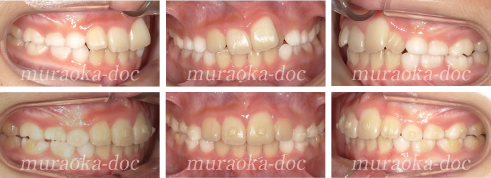 子どもの叢生・凸凹の矯正治療例(期間9ヵ月)