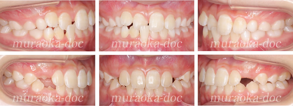 子どもの叢生・受け口の矯正治療例(期間1年3ヵ月)
