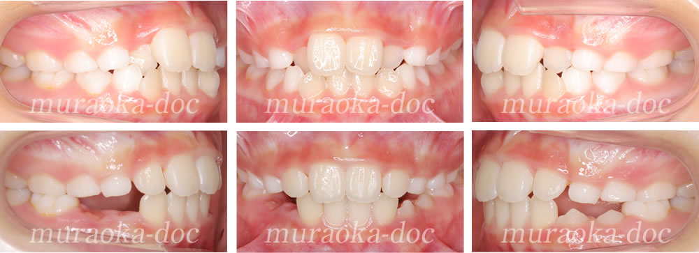 子どもの叢生・凸凹の矯正治療例(期間1年)