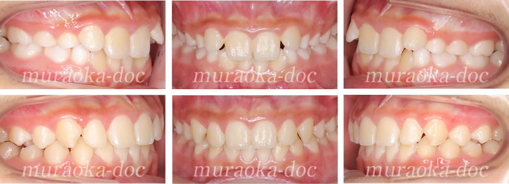 子どもの叢生・凸凹の矯正治療例(期間10ヵ月)