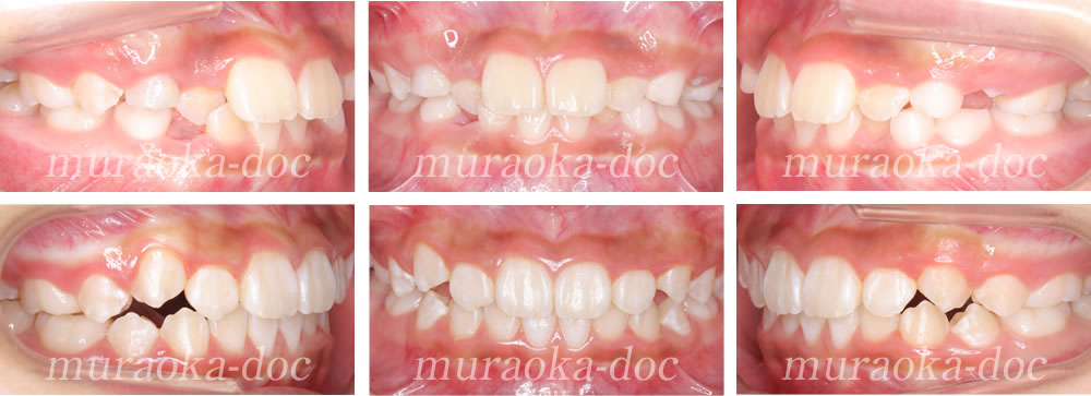 子どもの叢生・凸凹の矯正治療例(期間1年2ヵ月)