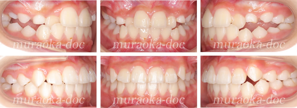 子どもの叢生・凸凹の矯正治療例(期間1年4ヵ月)