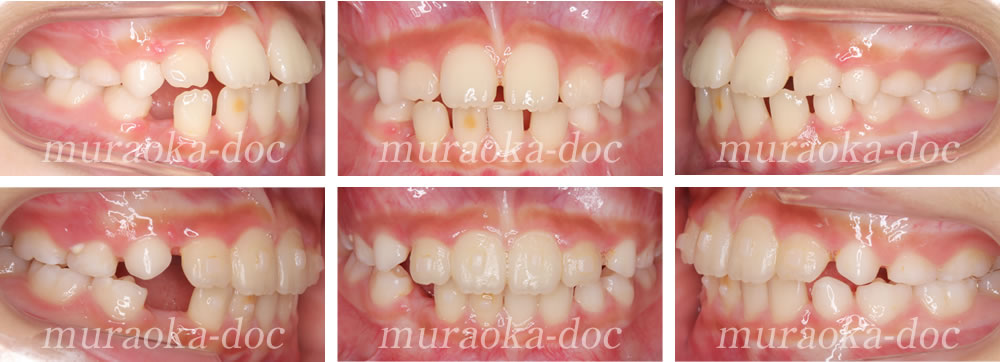 子どものすきっ歯の矯正治療例(期間10ヵ月)