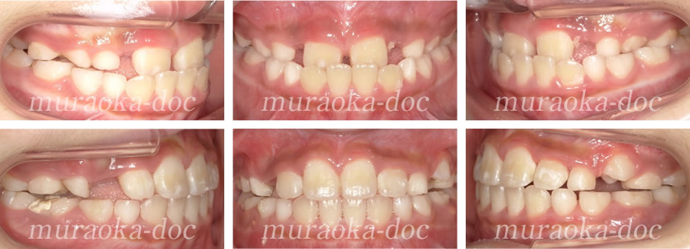 子どもの受け口の矯正治療例(期間1年3ヵ月)