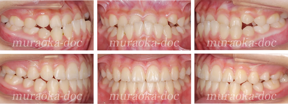 子どもの受け口の矯正治療例(期間10ヵ月)