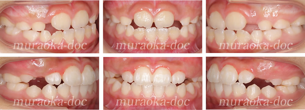 子どもの受け口の矯正治療例(期間1年4ヵ月)