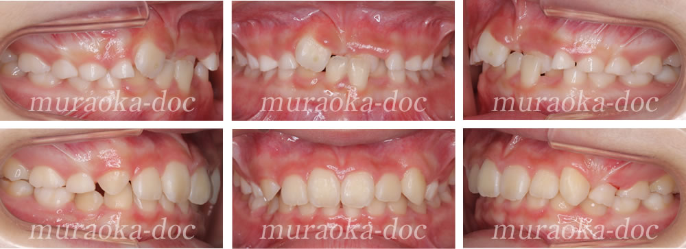 子どもの受け口・叢生の矯正治療例(期間1年6ヵ月)