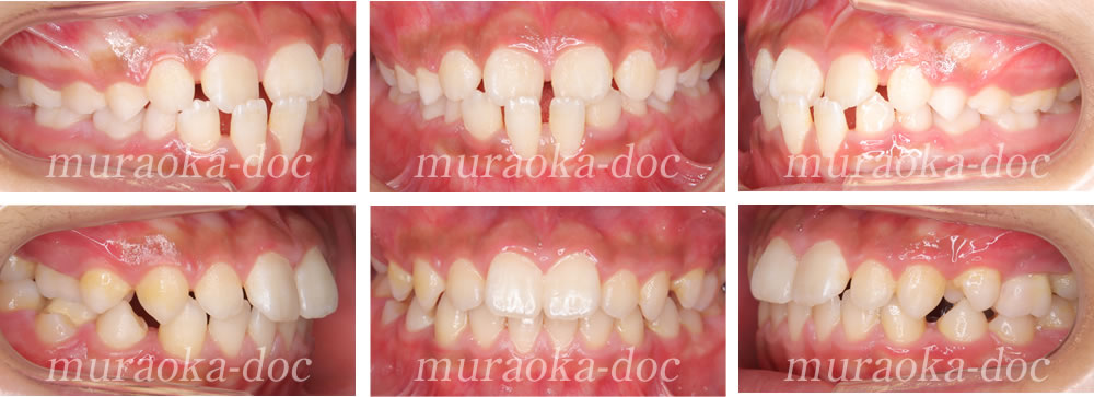 子どもの受け口・すきっ歯の矯正治療例(期間10ヵ月)