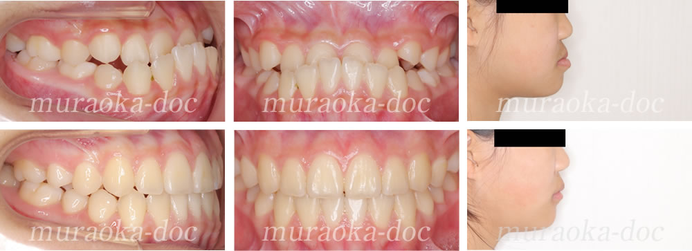 子どもの受け口の矯正治療例(期間1年5ヵ月)