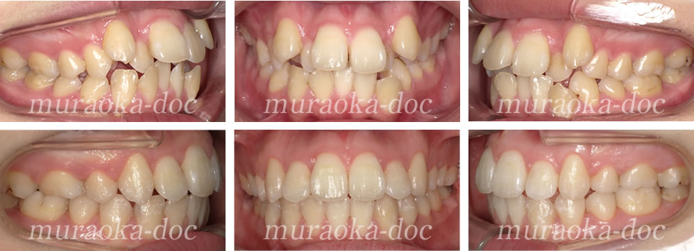 大人の八重歯・出っ歯の矯正治療例(期間1年6ヵ月)