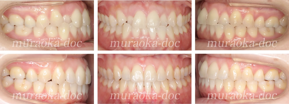 大人の叢生・八重歯の矯正治療例(期間1年2ヵ月)