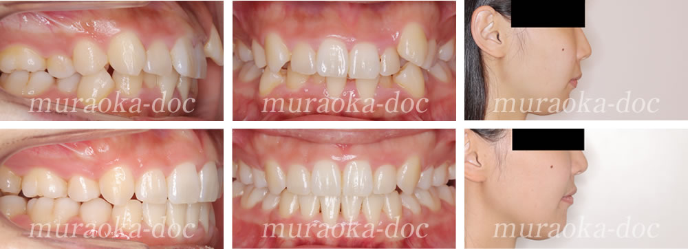 大人の叢生(凸凹)の矯正治療例(期間1年7ヵ月)