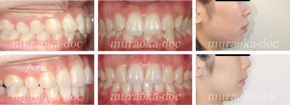 大人の叢生・過蓋咬合の矯正治療例(期間1年10ヵ月)