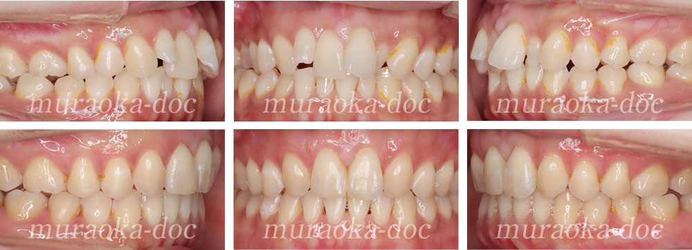 大人の叢生(凸凹)の矯正治療例(期間1年9ヵ月)