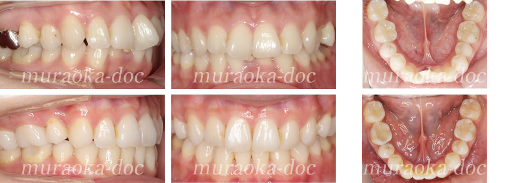 大人の叢生・過蓋咬合の矯正治療例(期間2年)