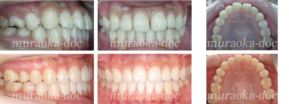 大人の叢生・すきっ歯の矯正治療例(期間1年)
