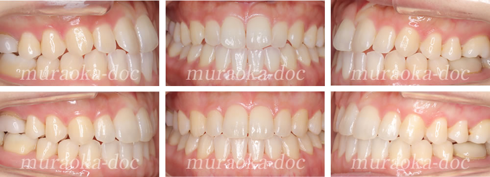 大人の叢生・凸凹・翼状捻転の矯正治療例(期間1年）