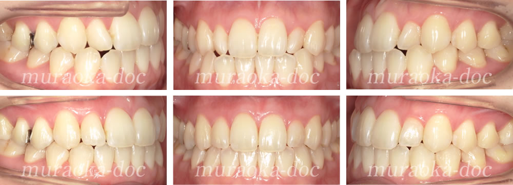 大人の叢生・凸凹の矯正治療例(期間1年)