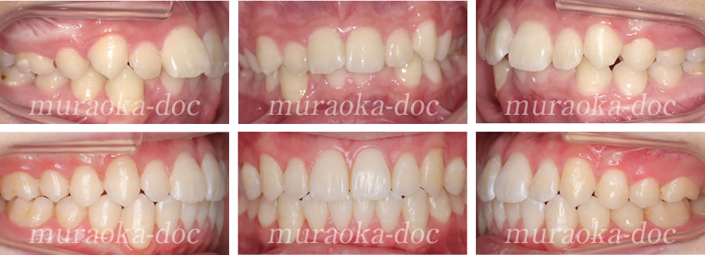 大人の叢生・過蓋咬合の矯正治療例(期間10ヵ月)